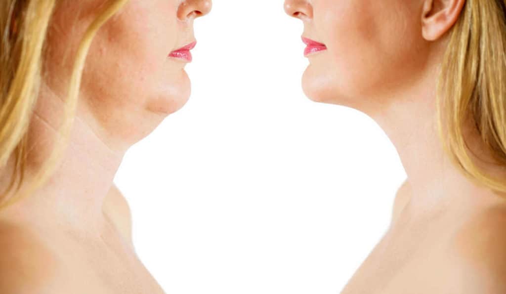 Double Chin treatment Wanstead before and after results