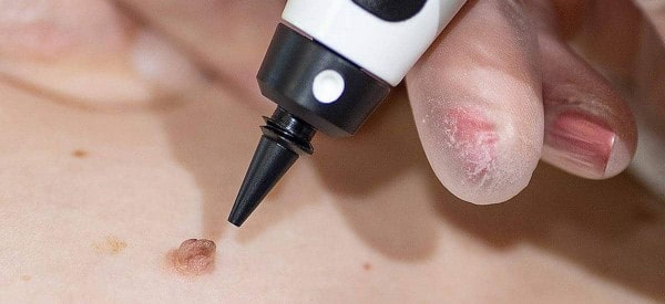 After Skin Tag Removal Wanstead