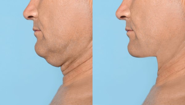 Which Non-Surgical Treatments Work Best for Jowls and Loose Skin Wanstead?