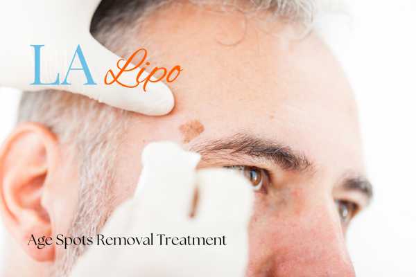 What Are the Most Effective Treatments for Age Spots Wanstead?