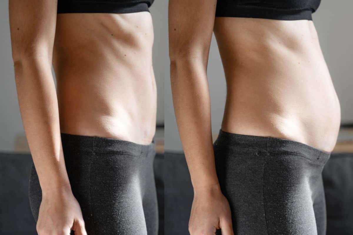 How long does diastasis recti take to improve Wanstead?