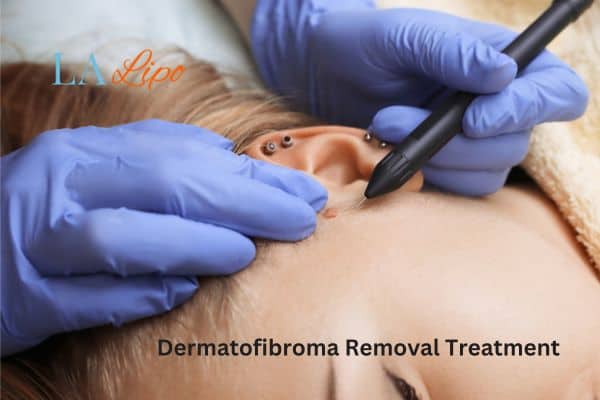 Dermatofibroma Removal Treatment Wanstead