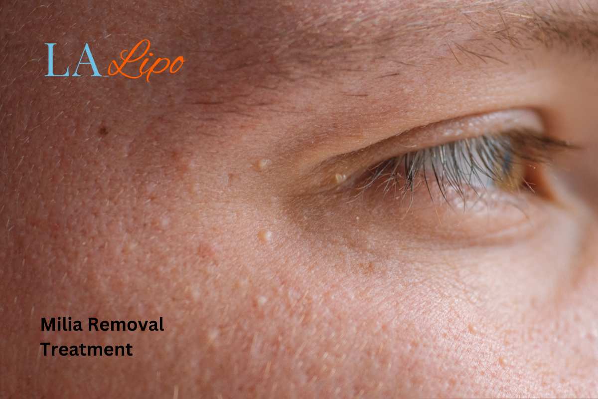 Cryopen Milia Removal: Is It the Easiest and Safest Option Wanstead?