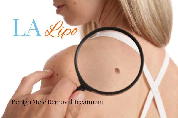 Woman having her inspection of blemish before mole removal Wanstead