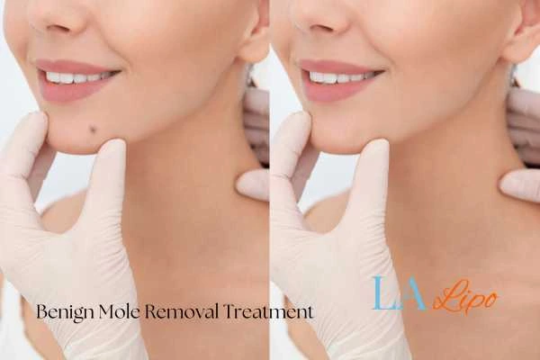 woman's before and after mole removal Wanstead results