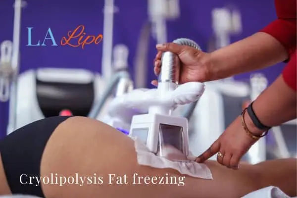 women getting fat freezing Wanstead