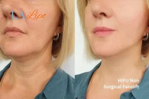 hi-fu for wrinkles Wanstead before and after results