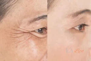 Before and after results of woman - HI-fu wrinkles reduction treatment Wanstead