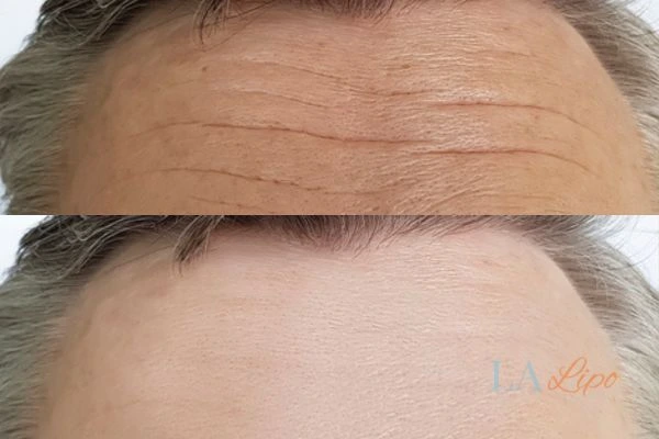 results of HIFU Wanstead on mans forehead to help reduce lines and wrinkles
