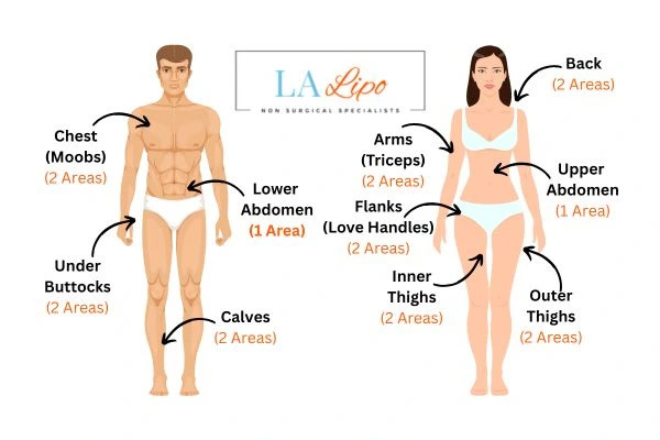 LA LIPO Cryolipolysis Areas Wanstead
