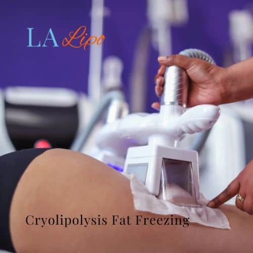 fat freezing - Cryolipolysis Wanstead