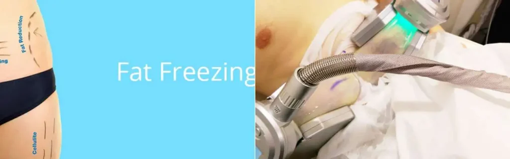 Fat freezing Wanstead on multiple areas of the body