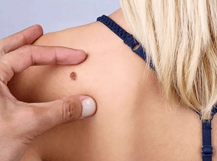 woman having mole removal Wanstead consultation before treatment.