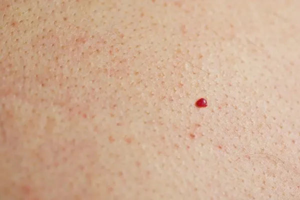 close up of a cherry angioma Wanstead