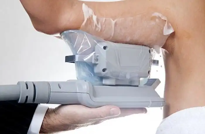 Picture of fat freezing Wanstead on the upper arms.