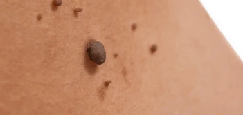 image of a skin tag Wanstead