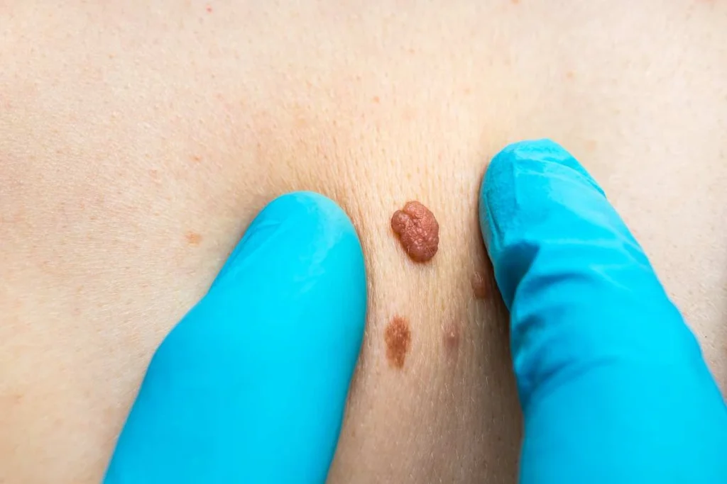 Consultant examining a skin tag Wanstead