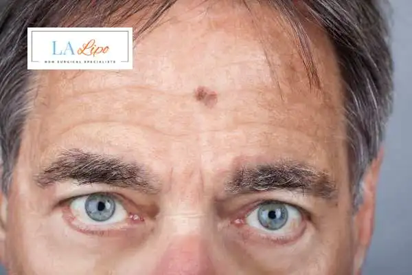 Solar Lentigo Removal Wanstead image of man with mark on his forehead