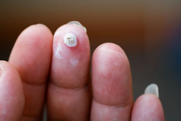 wart on person finger - cryotherapy to treat from LA LIPO Wanstead