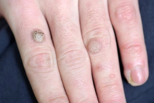 photo of warts on person hand - see wart removal Wanstead from LA LIPO