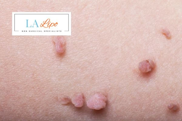 Does cryopen skin tag removal Wanstead hurt? Find out now call our team today!