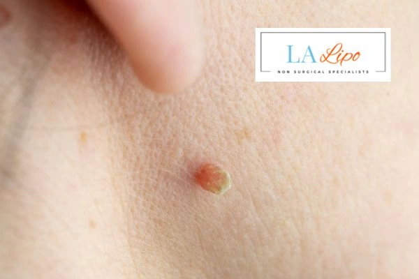 Book skin tag removal Wanstead today speak to our team now!