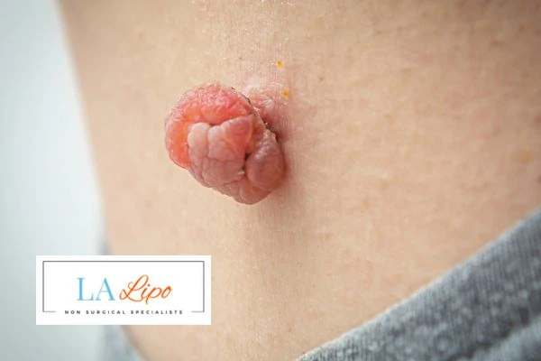 Interested in skin tag removal Wanstead? Concerned about the pain? Find out more today!