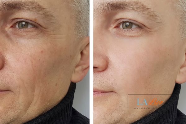 See the amazing results of Morpheus8 Treatment Wanstead!