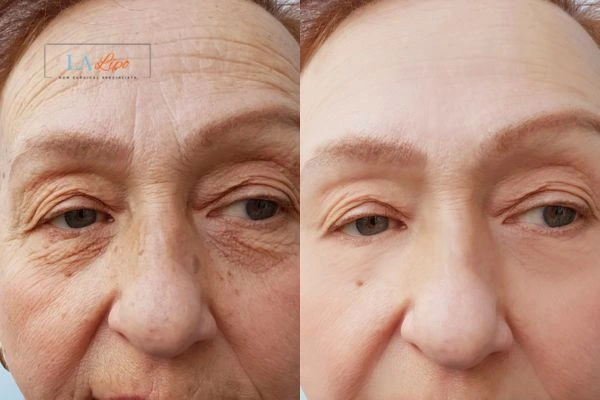 The powerful benefits of Morpheus8 Treatment Wanstead - Call Our team today!