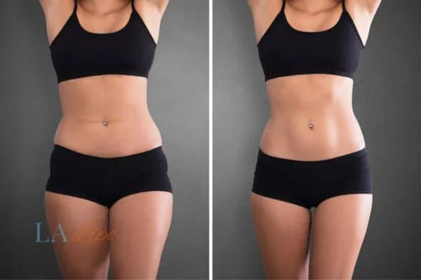 before and after results of non-surgical treatment to help a woman's body image and mental health Wanstead