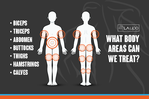 Diagram to show areas you can have LA-EMS Body Sculpting Treatment Wanstead