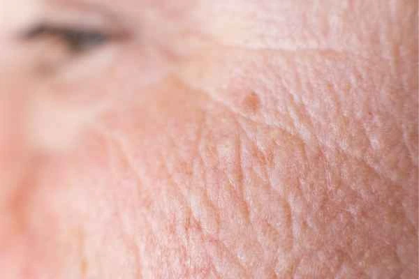 close up picture of a woman's face showing an age spot Wanstead