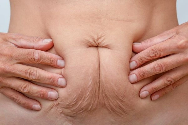 Image of a woman's stomach with loose skin - example of skin tightening Wanstead options