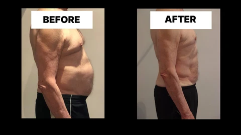What Symptoms Can Diastasis Recti Cause in Men? Weak Core, Back Pain and Poor Posture Wanstead